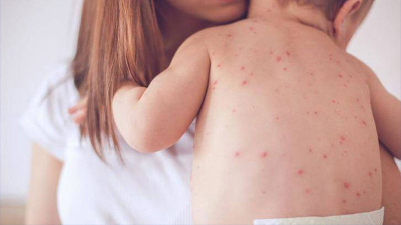 7 cách trị ngứa khi bị sốt phát ban tại nhà hiệu quả